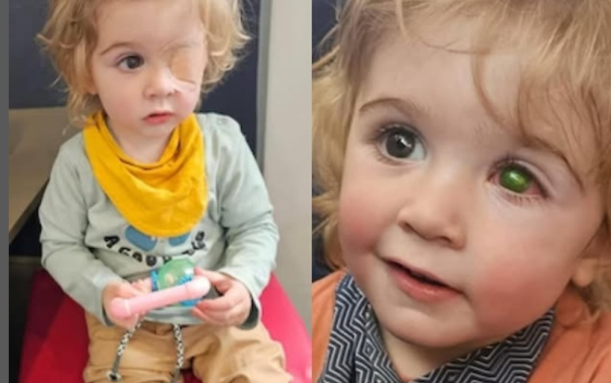 Menino de 2 anos perde a visão de um olho após beijo de pessoa com herpes labial