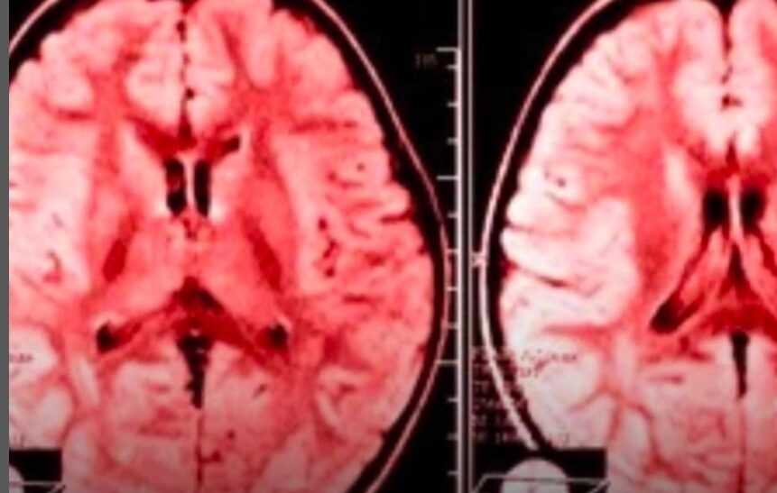 Ciência explica como o hábito de reclamar adoece nosso cérebro
