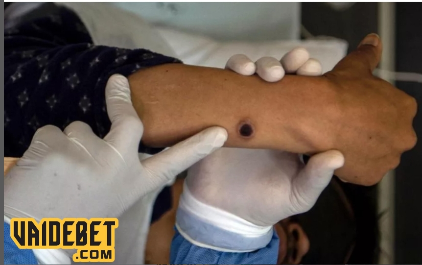 São Paulo confirma caso de nova doença derivada da MPOX com erupções, febre e dores