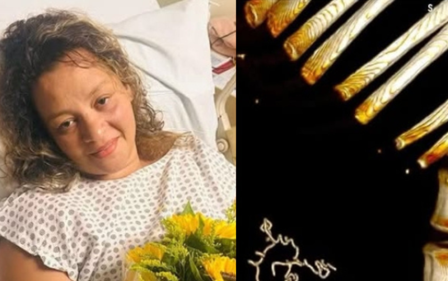 Mulher descobre compressa cirúrgica esquecida na barriga por médico após 5 anos de cesária