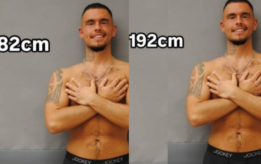 Jovem Alemão Enfrenta Cirurgias Dolorosas para Aumentar 24 cm de Altura: De 1,71 m para 1,95 m