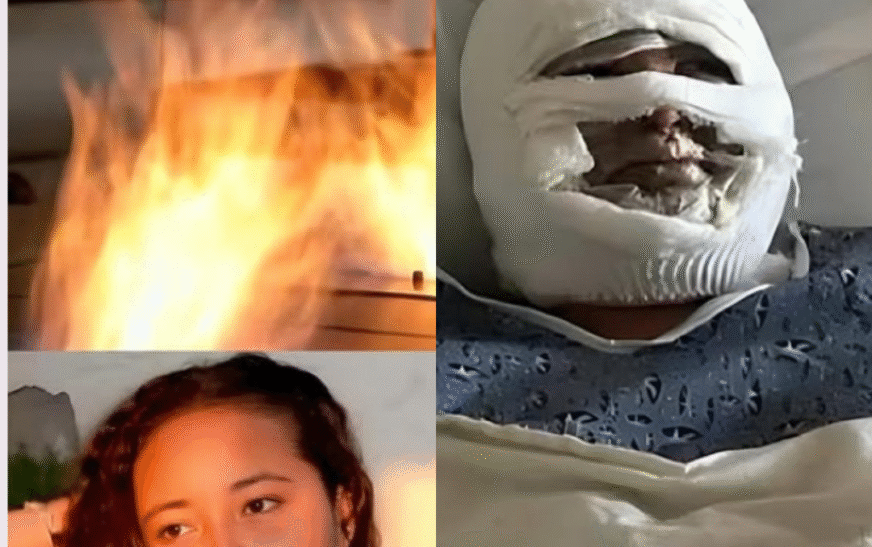 Jovem tem o rosto desfigurado ao tentar preparar marshmallow em lareira com álcool