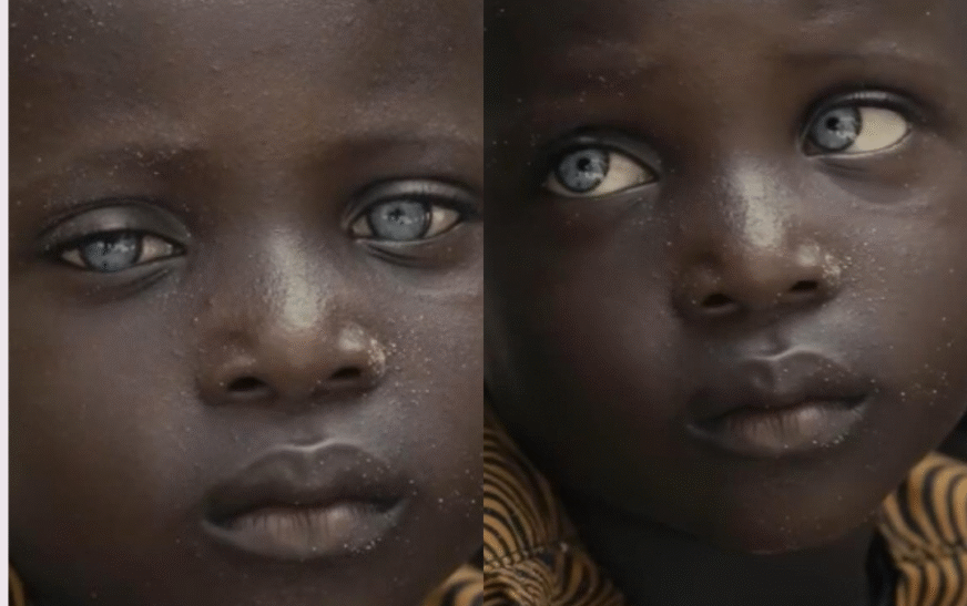 Menino do Benim Encanta com Raros Olhos Cinzentos, Presentes em Menos de 3% da População