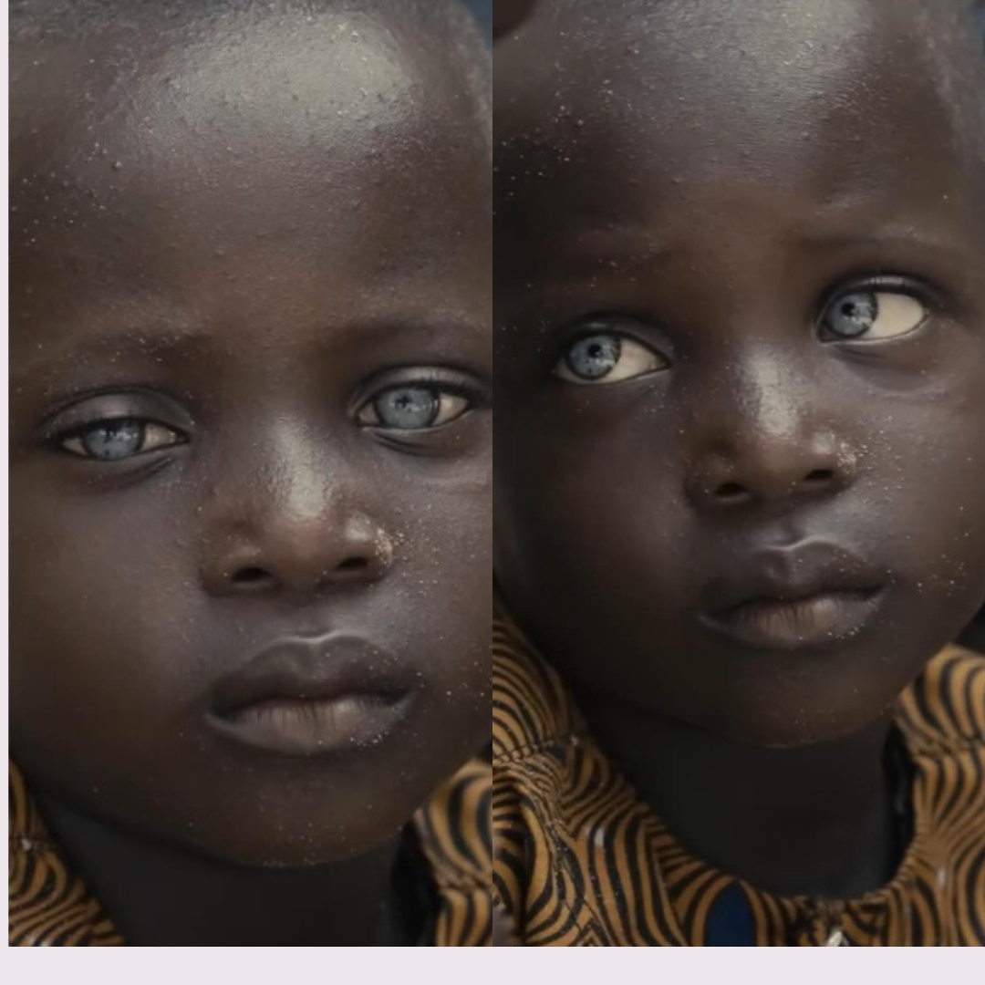 Menino do Benim Encanta com Raros Olhos Cinzentos, Presentes em Menos de 3% da População