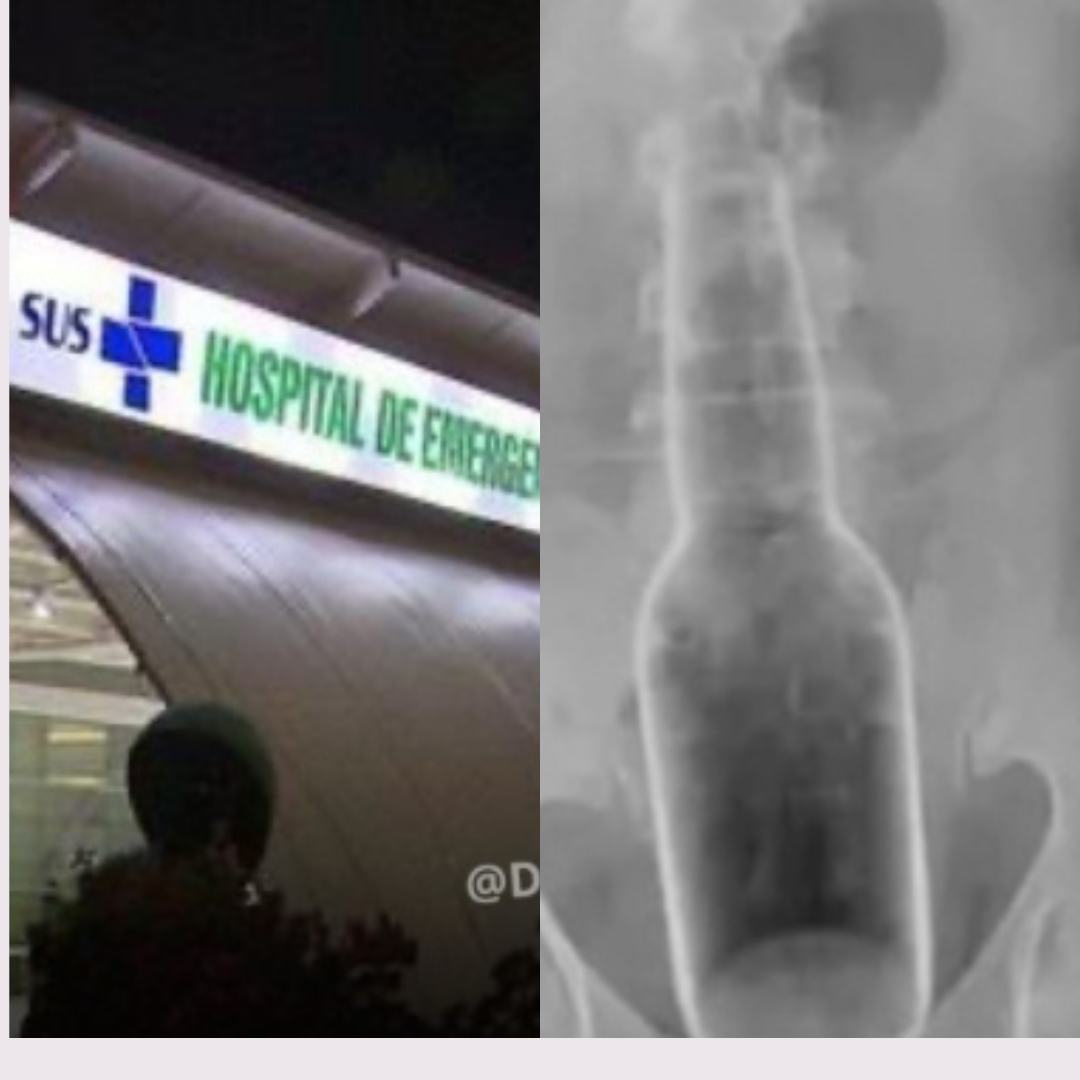 Homem fica com garrafa presa no reto ao tentar coçar as costas e busca ajuda em hospital