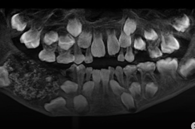 Médicos extraem 526 dentes da mandíbula de menino de 7 anos na Índia