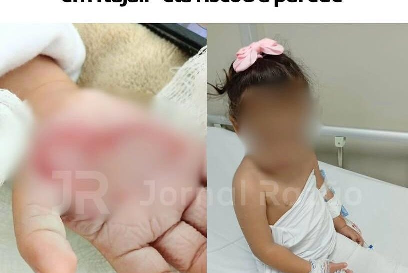 Crueldade em Itajaí: madrasta que queimou mão de menina de 2 anos é liberada